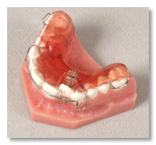Expansion Screws -Minor Tooth Movement & Space Management